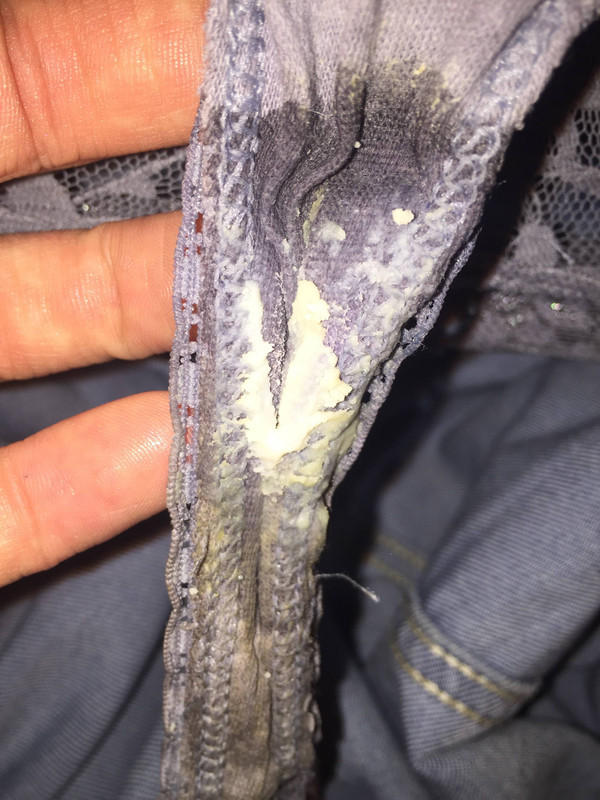 Creamy white discharge from vagina